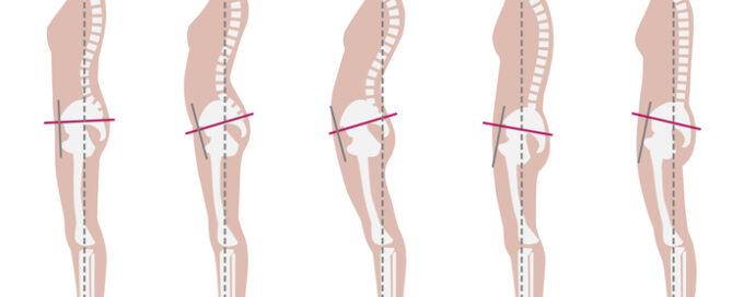 Side-view diagram comparing spinal posture types from aligned to slouched, representing posture improvement with Rolfing® in Rockville, MD